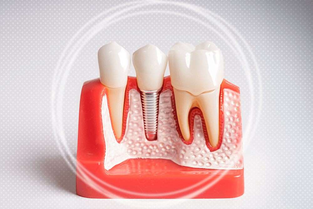 same day teeth implants