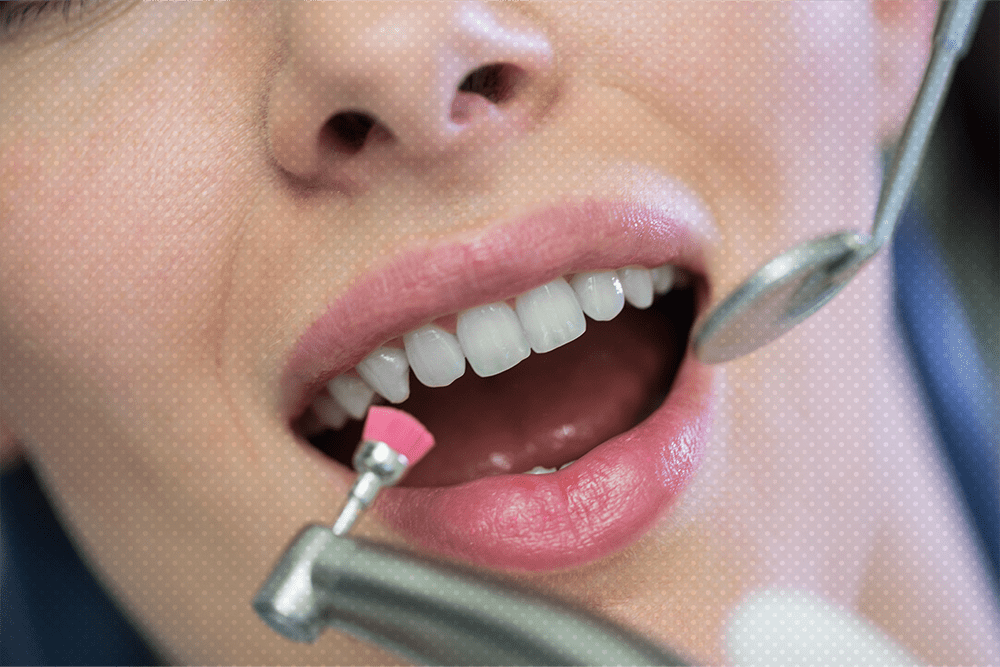 teeth scaling and polishing
