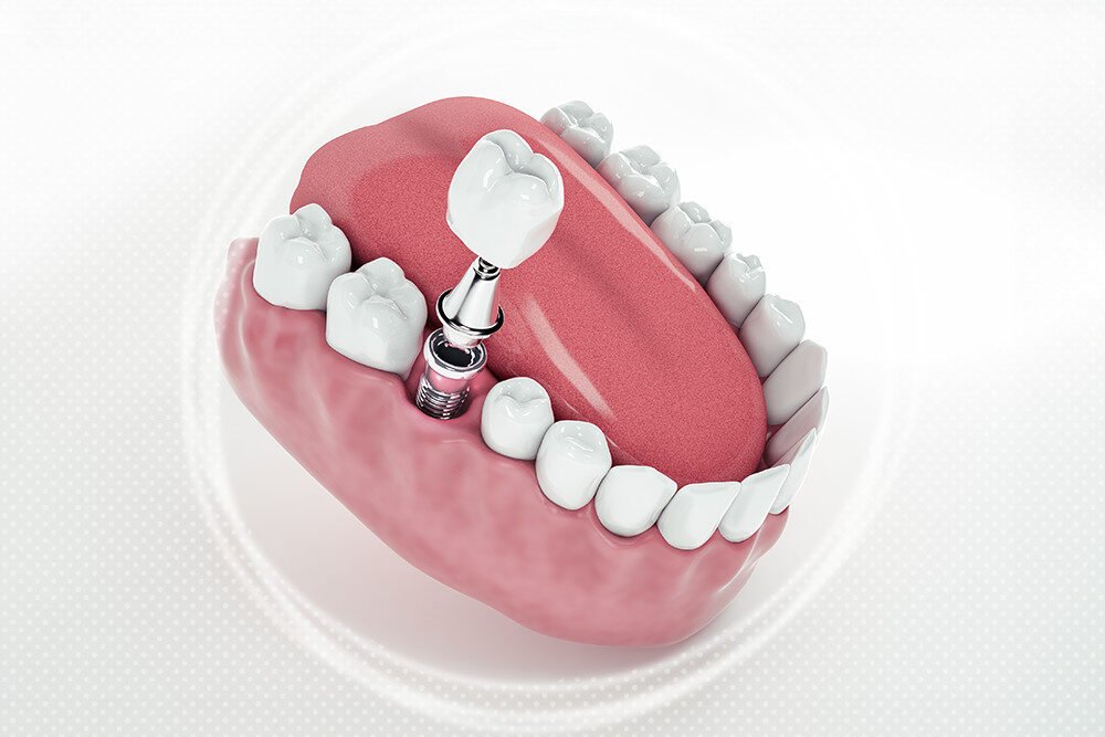 10 Key Facts About Cosmetic Dental Implants You Should Know