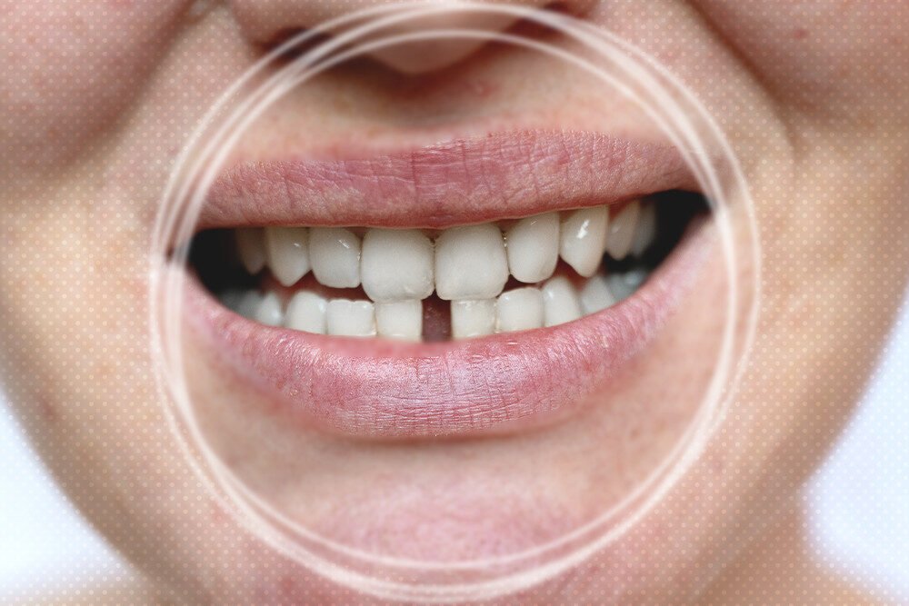 How To Fix A Gap In Your Teeth: A Dentist's Advice