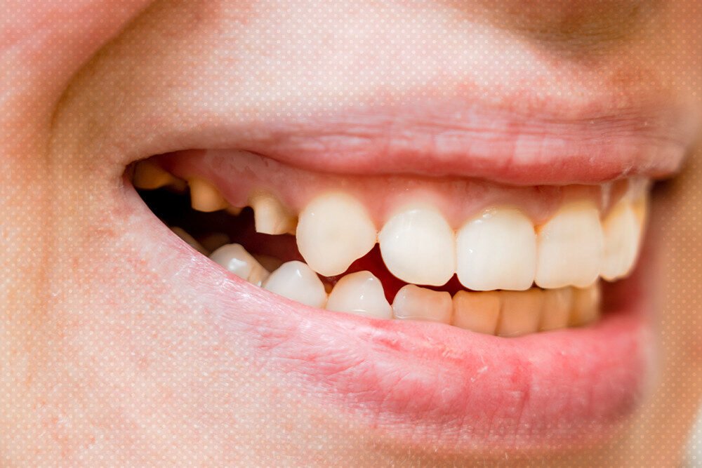 How To Fix Teeth That Have Been Ground Down: Expert Advice