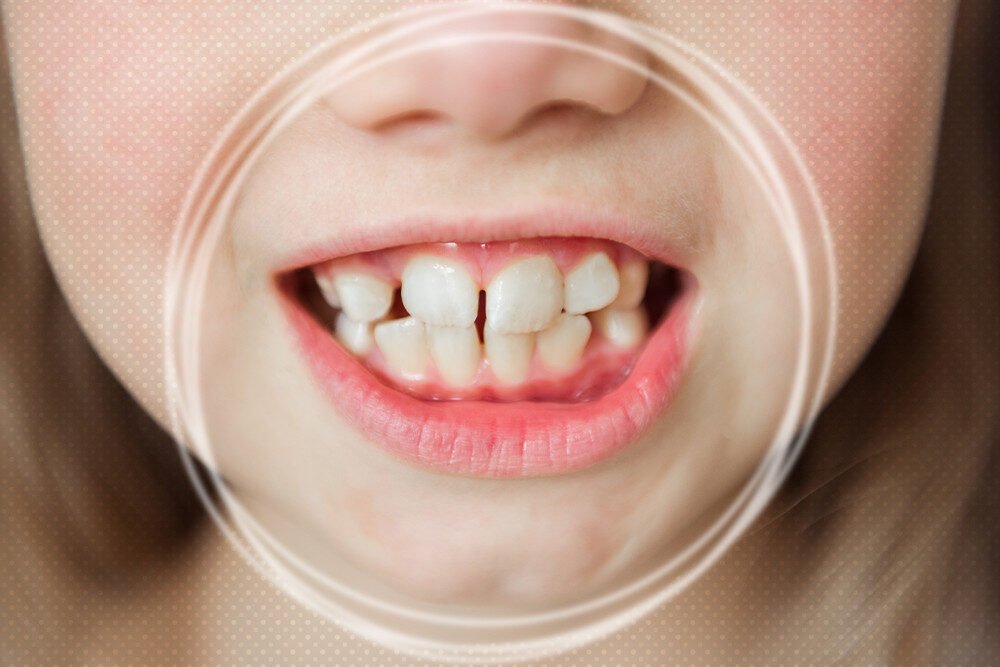 How To Fix Teeth That Stick Out: All Trusted Methods